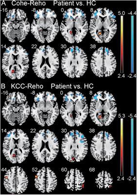 Alterations of Regional Homogeneity in Children With Congenital Sensorineural Hearing Loss: A Resting-State fMRI Study